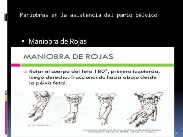 maniobras para parto podalico